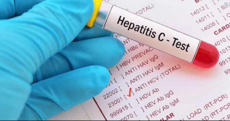 Hepatitis C home tests introduced as ‘tens of thousands’ live with it without&nbsp;knowing