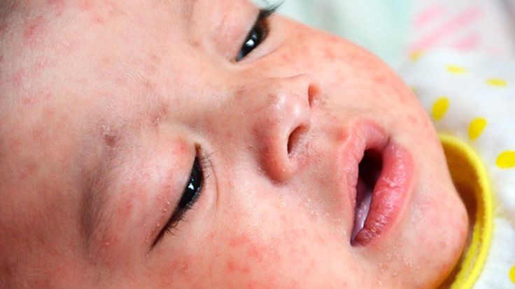 There has been a warning of a potential measles outbreak in London, with the potential to affect tens of thousands of&nbsp;people.