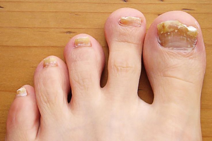 5 Ways To Fight Toenail Fungus Using Home&nbsp;Treatments