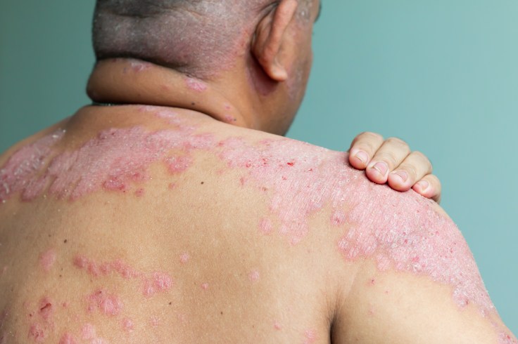 5 Home Remedies For&nbsp;Psoriasis