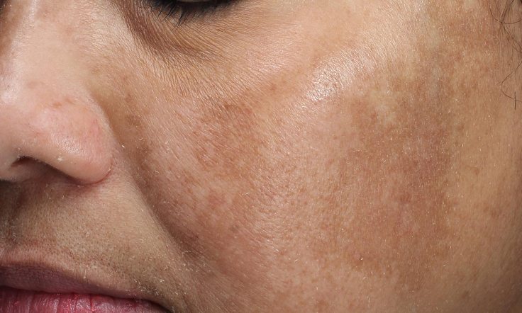 7 Natural Ways To Fade Facial Dark&nbsp;Spots